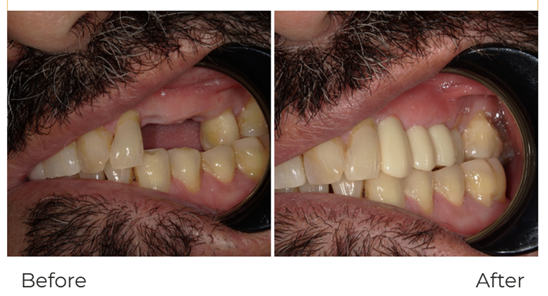 Dental-Implants
