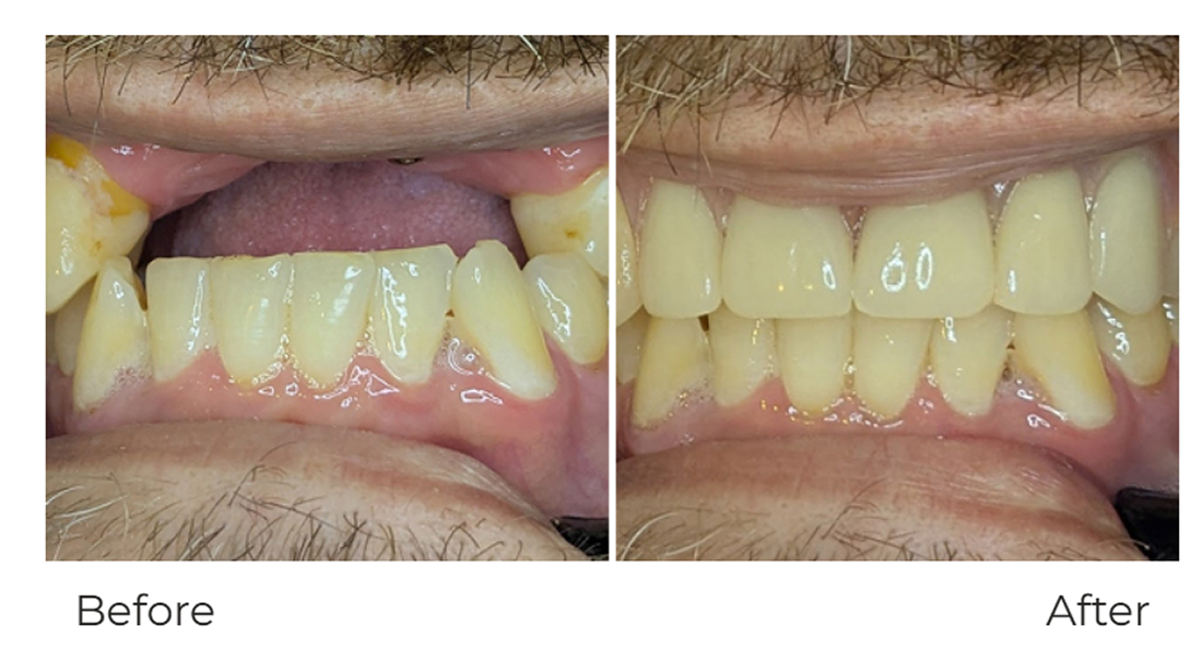 Dental-Implants
