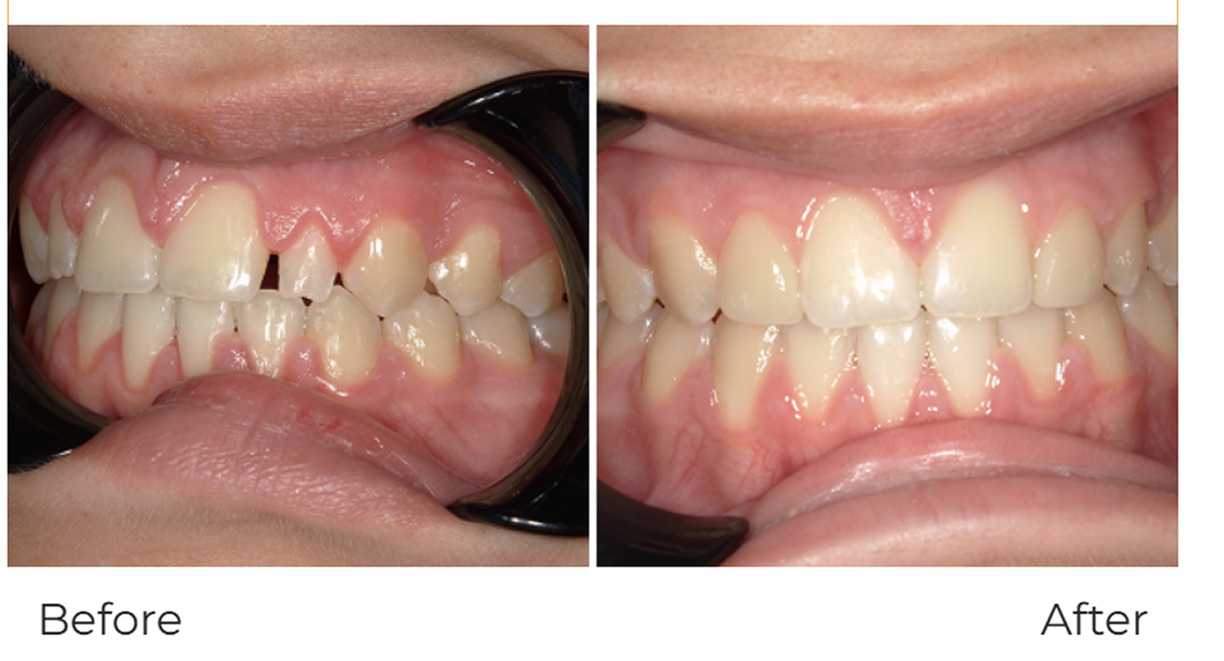 Invisalign