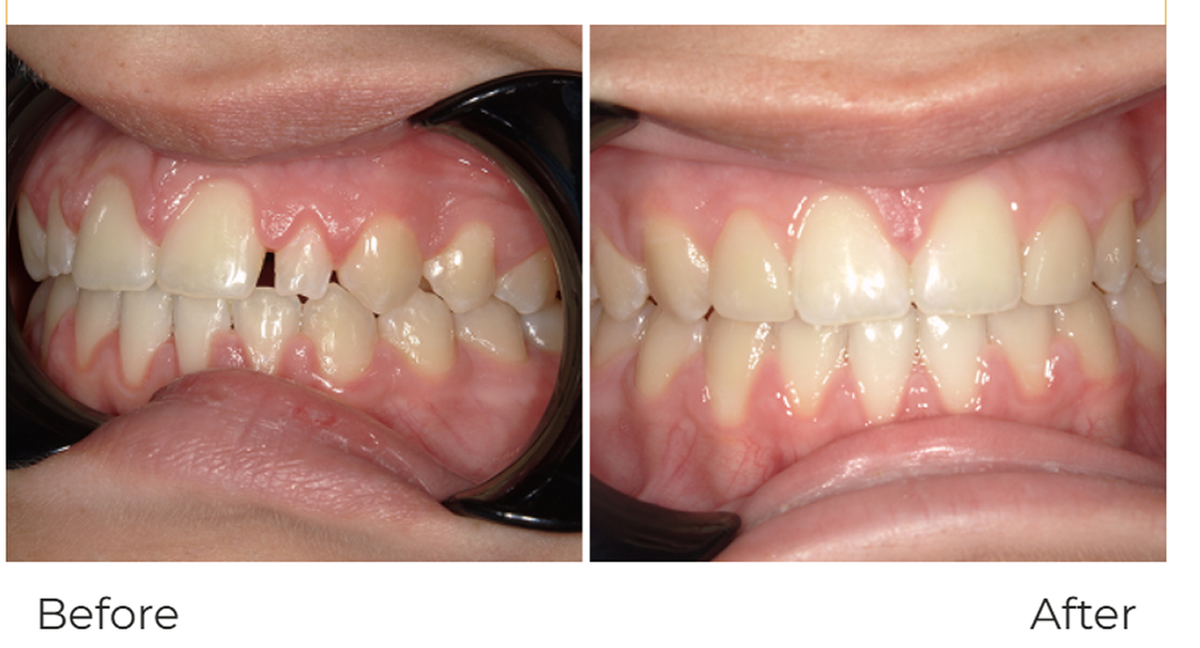 Veneers