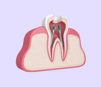 6 Things to Know About Root Canal
