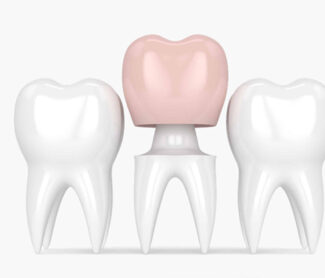 6 Important Facts To Know About Dental Crowns