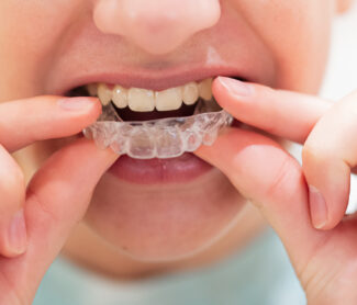 How Long Does Invisalign Treatment Take?