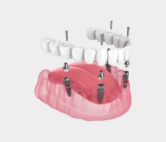 All-on-4-Dental-Implants-Top-5-Trends-in-2026-for-Faster-Recovery-and-Safety