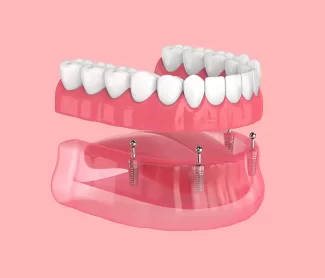 Dental Implants vs. Dentures: Which Is Right for You in Keller, TX?